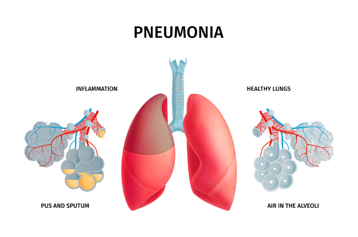 Pneumonia Treatment